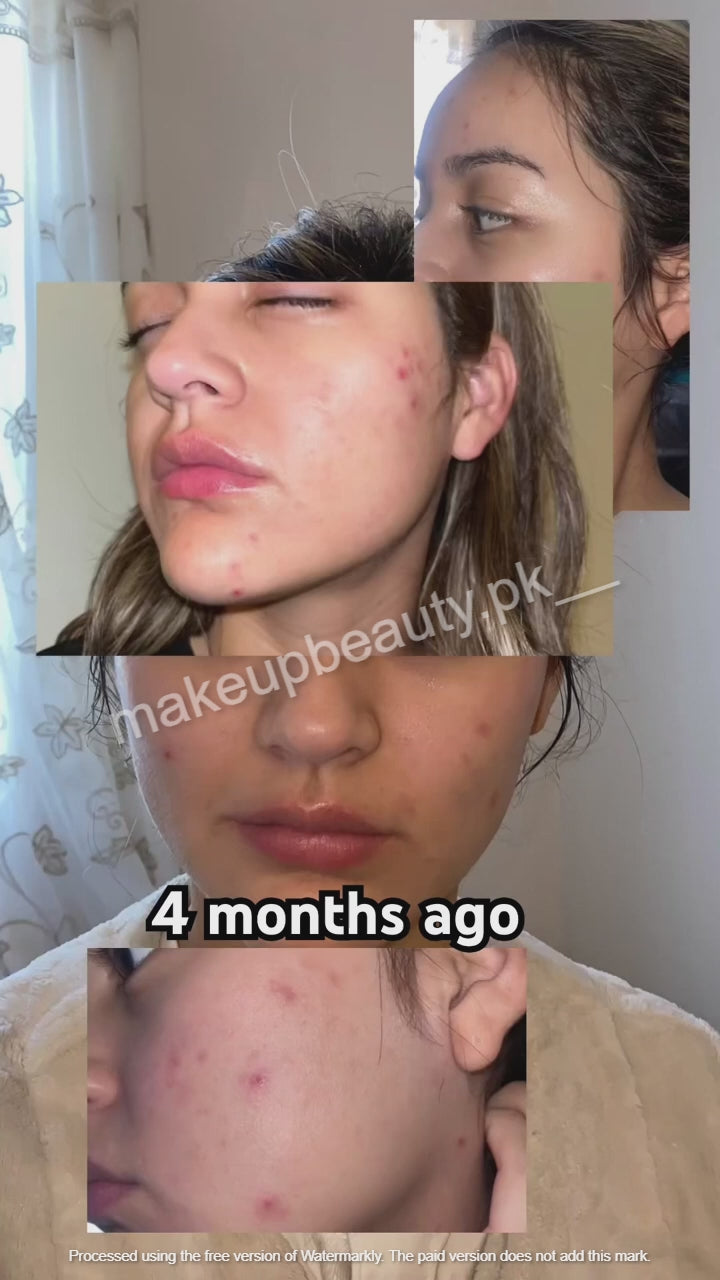 Panoxyl Acne Foaming Wash (10% Benzoyl Peroxide ). 156 Grams